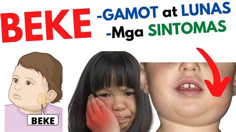 Gamot AT Lunas sa BEKE at mga SINTOMAS | Beke o MUMPS sa BATA, Matanda ...