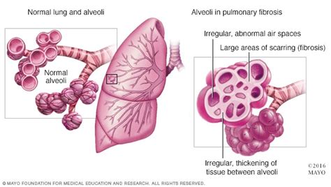 What Is the Prognosis for Pulmonary Fibrosis? - Responsum Health