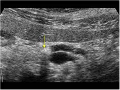 Abdomen and retroperitoneum | 1.3 Pancreas : Case 1.3.7 Pancreas ...