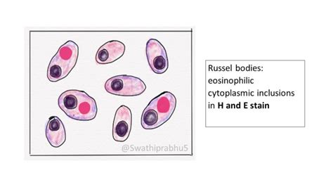 Pathology of Multiple Myeloma | Pathology Made Simple