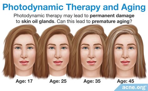 Photodynamic Therapy - PDT - Acne.org