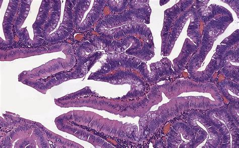 Tubular Adenoma Histology