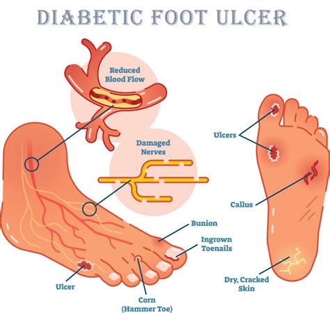 Diabetic Ulcers and Sores: Know Causes, Treatment and Prevention ...