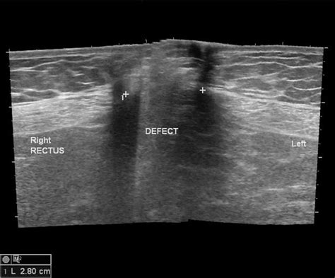 Ventral Hernia Ultrasound