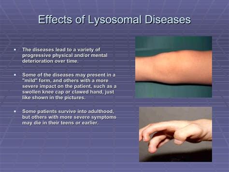 Lysosomal Storage Disease