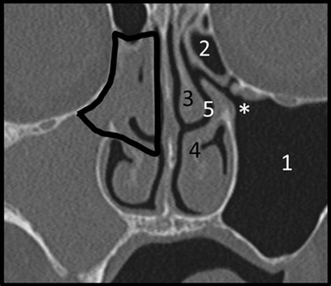 Aperture width of the osteomeatal complex as a predictor of successful ...