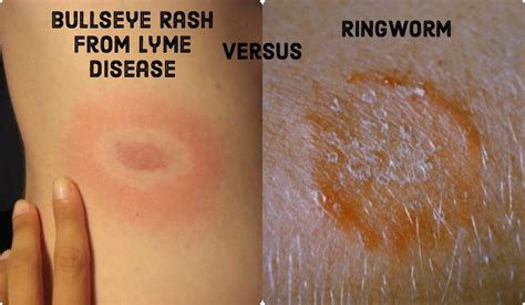 Bullseye Rashes: Ringworm and Lyme Disease Differences | HealDove