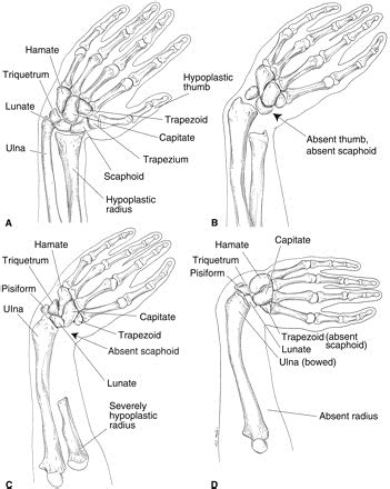 Radial Clubhand (radial deficiency) - Hand - Orthobullets