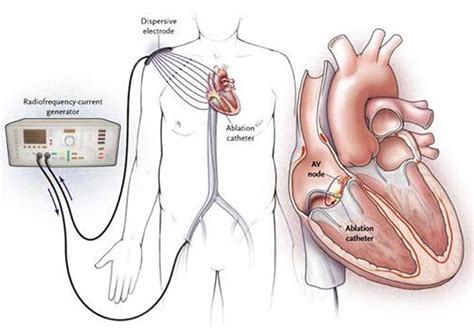 Heart Surgery Types - Open, Bypass, Ablation, Heart Valve surgery