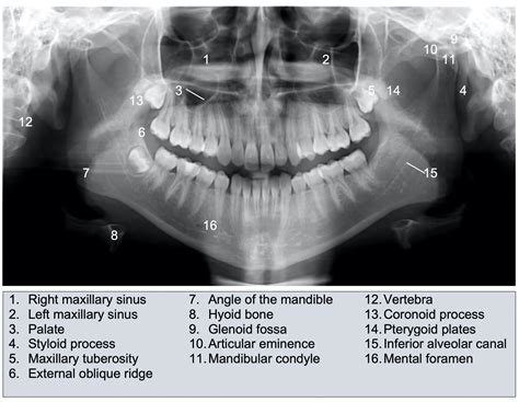 Mandibular Fracture X Ray