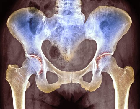 Osteoarthritis Of Hip Joints, X-ray Photograph by