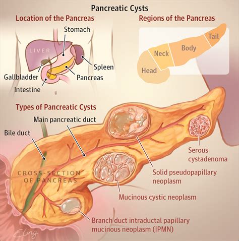 Types of Pancreatic Cysts | Gastroenterology | JAMA | JAMA Network ...