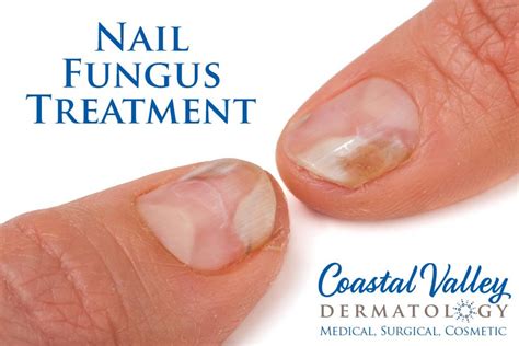 Nail Fungus - Coastal Valley Dermatology