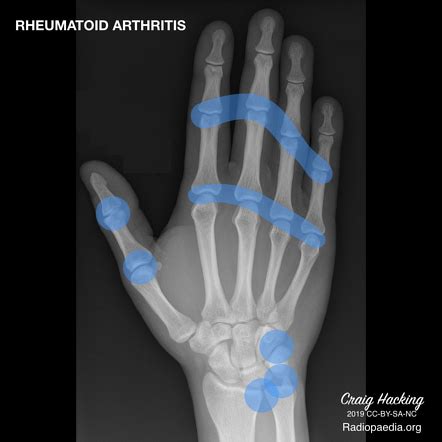 Rheumatoid Arthritis Hands X Ray