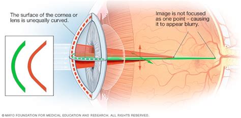 Astigmatism - Symptoms and causes - Mayo Clinic