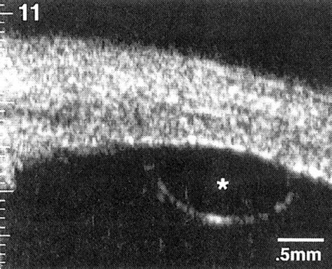 High-resolution ultrasound biomicroscopy of the pars plana and ...