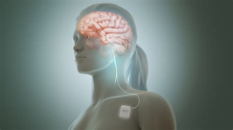 Treatment for trapped nerve | General center | SteadyHealth.com