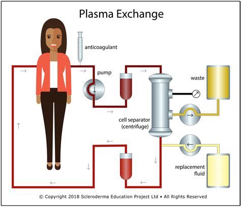 Therapeutic Plasma Exchange as a Treatment for Systemic Sclerosis ...