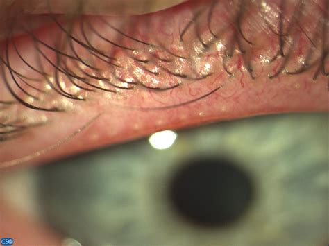 What are the causes of meibomian gland dysfunction