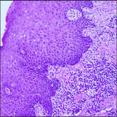 Gingival Hyperplasia Histology