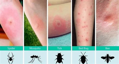 Bed Bug Bites vs. Flea Bites | 3 Critical Differences To Know [With ...