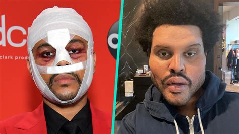 The Weeknd Finally Explains The Meaning Behind His Face Bandages ...