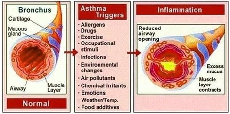 Asthma Triggers Image - Graph Diagram