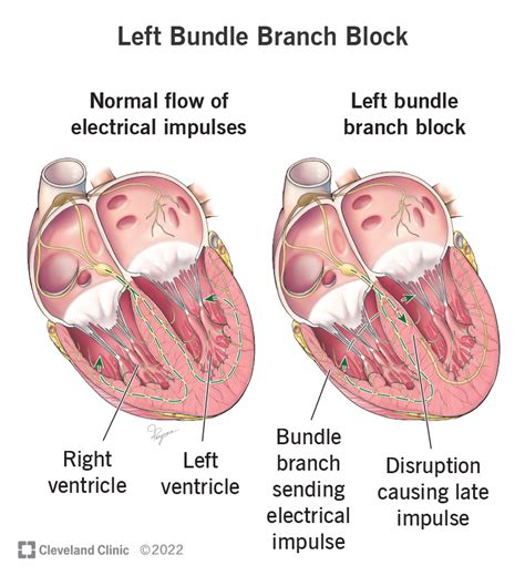 Left Bundle Branch Block: Causes, Symptoms & Treatment