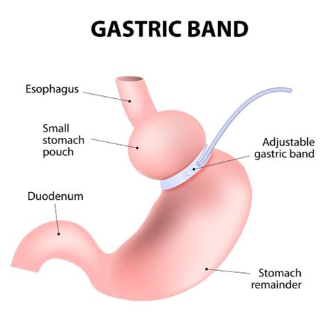 Lap Band Complications - How Safe Is Lap Band Surgery? | BMCC