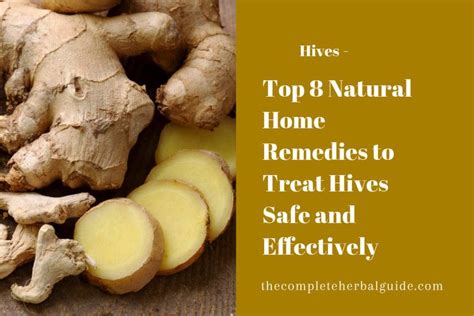 8 Ways to Get Rid of Hives | Hives, Hives remedies, Chronic hives