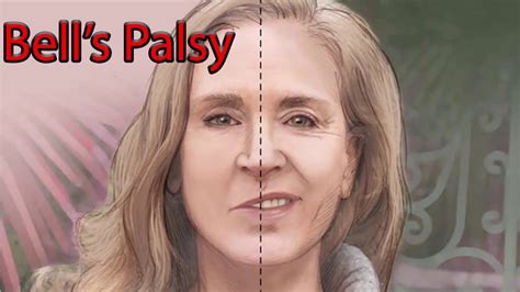 Facial Palsy: What Causes It and How To Deal With It?