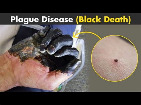 Black Death Symptoms