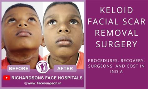 Keloid Facial Scar Removal | Procedures, Recovery, Surgeons, and Cost ...