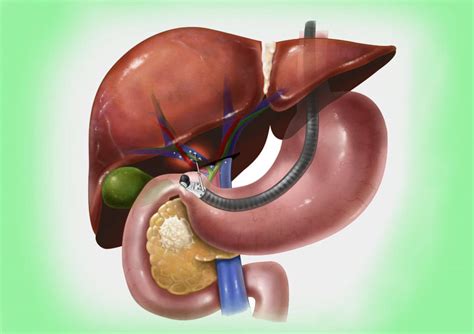 ERCP | Endoscopic Retrograde Cholangiopancreatography