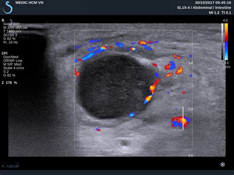 Cervical Lymph Nodes Ultrasound