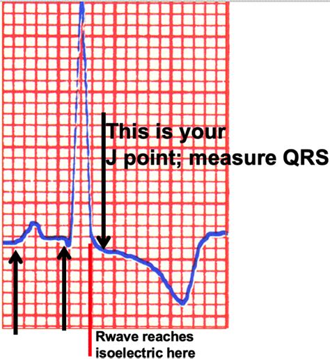 PRI and QRS Measurements