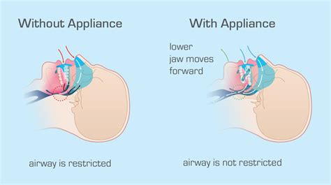 Silent Nite® for Snoring & Sleep Apnea | New West