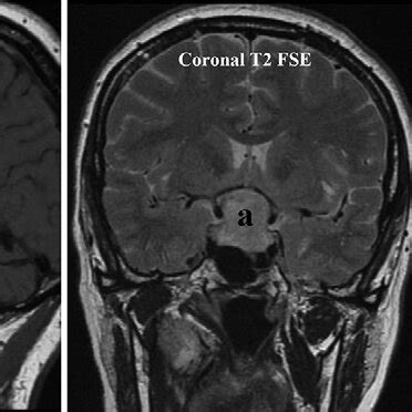 Brain MRI scans showing blood and hemostatic material (a) in the sella ...