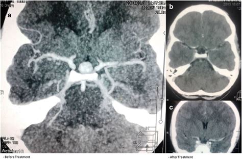 Pituitary hyperplasia CT scan. (Left) Pituitary hyperplasia appearing ...