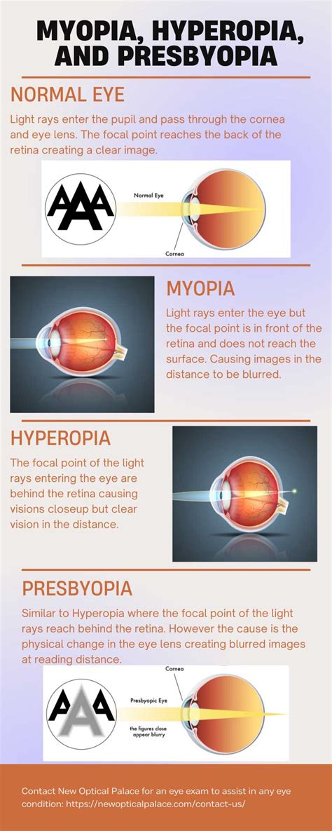 near sighted vs far sighted vs astigmatism - Lauretta Haney