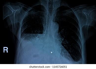 Ct Scan Hydropneumothorax Stock Photo 1145726051 | Shutterstock