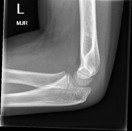 Normal elbow x-ray (7 year old) | Radiology Case | Radiopaedia.org