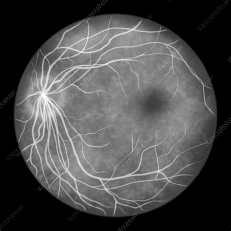 Fluorescein angiogram of a healthy retina, illustration - Stock Image ...