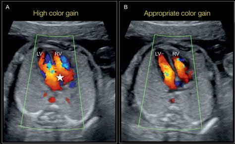 What Does Color On An Ultrasound Mean - Hollingsworth Philip