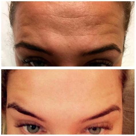 botox before after pictures forehead wrinkles (2) » Facial Injections ...