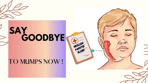 How to Cure MUMPS at Home Fast ! || 3 Excellent Home Remedies for Mumps ...