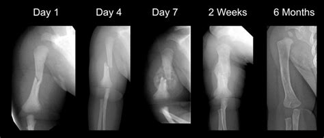 Fracture Education : Fracture healing