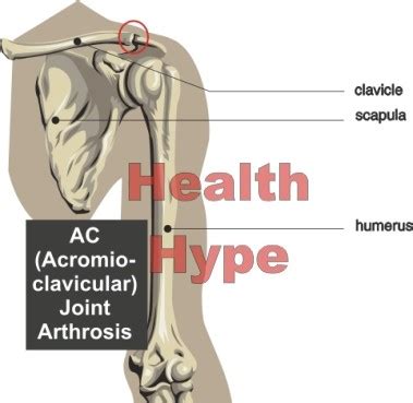 Arthrosis Define, Causes, Symptoms Treatment, Difference | Healthhype.com