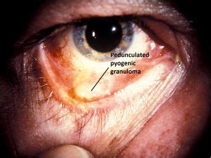 Pyogenic Granuloma Eye Treatment