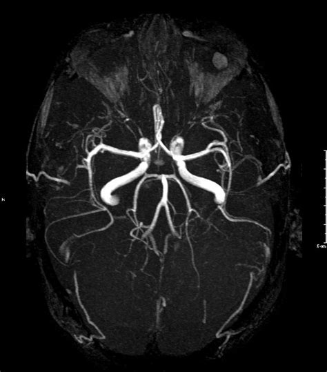 Brain Aneurysm Mri With Contrast : To obtain an accurate mri image of ...